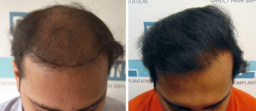 DHI before & after hair transplant results